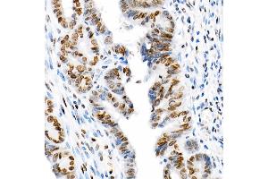 Immunohistochemistry of paraffin-embedded human colon carcinoma using Acetyl-Histone H3-K9 Rabbit mAb (ABIN7267667) at dilution of 1:200 (40x lens). (Histone 3 antibody  (H3K18))