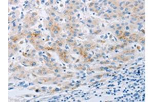 The image on the left is immunohistochemistry of paraffin-embedded Human liver cancer tissue using ABIN7191702(NPY2R Antibody) at dilution 1/20, on the right is treated with synthetic peptide. (NPY2R antibody)
