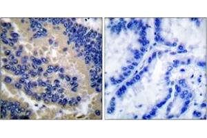 Immunohistochemistry analysis of paraffin-embedded human lung carcinoma tissue, using Caspase 3 (Cleaved-Asp175) Antibody. (Caspase 3 antibody  (Cleaved-Asp175))