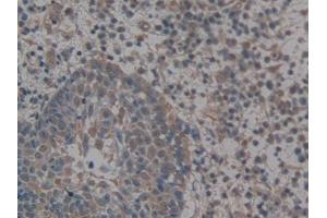 IHC-P analysis of Human Skin cancer Tissue, with DAB staining. (GLG1 antibody  (AA 1048-1145))