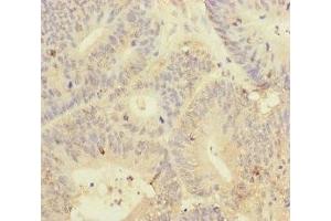 Immunohistochemistry of paraffin-embedded human colon cancer using ABIN7145011 at dilution of 1:100 (YME1L1 antibody  (AA 1-240))