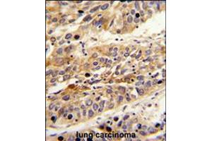 Formalin-fixed and paraffin-embedded human lung carcinoma reacted with LRG1 Antibody , which was peroxidase-conjugated to the secondary antibody, followed by DAB staining. (LRG1 antibody  (AA 194-223))