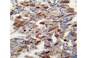 IHC analysis of FFPE human lung carcinoma with CD31 antibody (CD31 antibody  (AA 690-718))