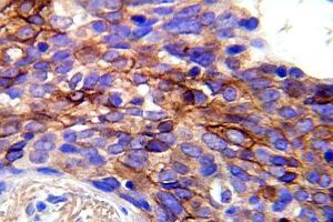 Immunohistochemistry (IHC) analyzes of p-EGFR antibody in paraffin-embedded human lung carcinoma tissue. (EGFR antibody  (pTyr1092))