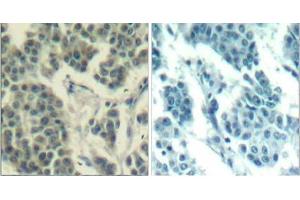 Immunohistochemical analysis of paraffin- embedded human breast carcinoma tissue using Her3/ErbB3 (phospho-Tyr1328) Antibody (E011510) . (ERBB3 antibody  (pTyr1328))
