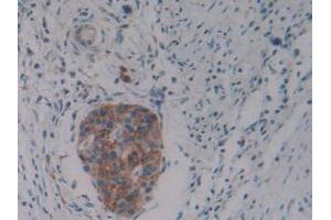 IHC-P analysis of Human Pancreas Cancer Tissue, with DAB staining. (PKIB antibody  (AA 8-76))