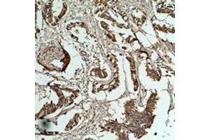 Immunohistochemical analysis of HSP27 staining in human breast cancer formalin fixed paraffin embedded tissue section. (HSP27 antibody)
