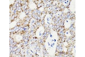 Immunohistochemistry of paraffin-embedded Human colon carcinoma using PDCD10 Polyclonal Antibody at dilution of 1:100 (40x lens). (PDCD10 antibody)