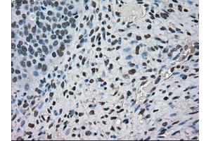 Immunohistochemical staining of paraffin-embedded Carcinoma of kidney tissue using anti-FERMT2mouse monoclonal antibody. (FERMT2 antibody)