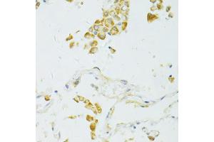 Immunohistochemistry of paraffin-embedded human lung cancer using SIRT2 antibody. (SIRT2 antibody)