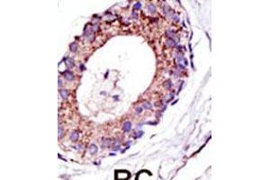 Formalin-fixed and paraffin-embedded human cancer tissue reacted with the primary antibody, which was peroxidase-conjugated to the secondary antibody, followed by DAB staining. (UBE4A antibody  (C-Term))