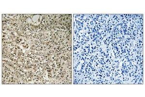 Immunohistochemistry analysis of paraffin-embedded human breast carcinoma tissue using RPL40 antibody. (UBA52 antibody  (C-Term))