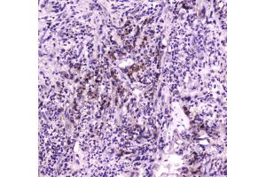 IHC testing of FFPE human intestine cancer tissue with NPC2 antibody at 1ug/ml. (NPC2 antibody)