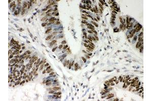 Anti- Nucleophosmin Picoband antibody,IHC(P) IHC(P): Human Intestinal Cancer Tissue (NPM1 antibody  (AA 1-294))