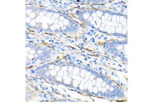 Immunohistochemistry of paraffin-embedded human liver cancer using LPP Rabbit mAb (ABIN7268284) at dilution of 1:100 (40x lens). (LPP antibody)