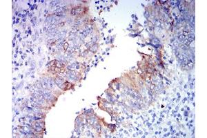 Immunohistochemical analysis of paraffin-embedded rectum cancer tissues using GRIA2 mouse mAb with DAB staining. (GRIA2 antibody  (AA 35-175))