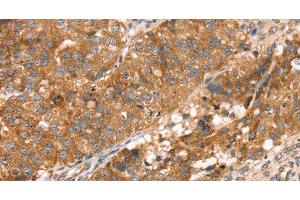 Immunohistochemistry of paraffin-embedded Human breast cancer using PDLIM4 Polyclonal Antibody at dilution of 1:30 (PDLIM4 antibody)