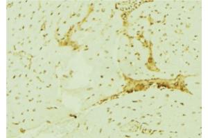 ABIN6277468 at 1/100 staining Human breast cancer tissue by IHC-P. (CDK6 antibody  (N-Term))