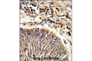 Formalin-fixed and paraffin-embedded human lung carcinoma reacted with HSPA6 Antibody , which was peroxidase-conjugated to the secondary antibody, followed by DAB staining. (HSPA6 antibody  (C-Term))