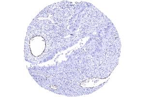 Ovary Serous high grade carcinoma showing distinct endothelial vWF staining in a subset of intratumoral vessels (Recombinant VWF antibody  (AA 1815-1939))