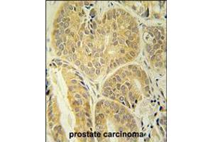 ENAM antibody immunohistochemistry analysis in formalin fixed and paraffin embedded human prostate carcinoma followed by peroxidase conjugation of the secondary antibody and DAB staining. (Enamelin antibody  (C-Term))