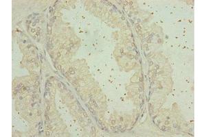 Immunohistochemistry of paraffin-embedded human prostate cancer using ABIN7168124 at dilution of 1:100 (RPP25L antibody  (AA 1-163))