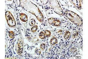 Formalin-fixed and paraffin embedded human colon carcinoma labeled with Rabbit Anti-JAK2 Polyclonal Antibody (ABIN730513), Unconjugated 1:200 followed by conjugation to the secondary antibody and DAB staining (CD38 antibody  (AA 81-180))