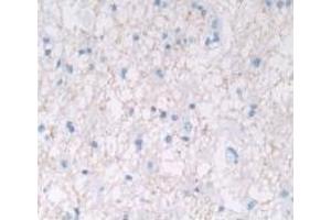 Detection of IL28A in Human Glioma Tissue using Monoclonal Antibody to Interleukin 28A (IL28A) (IL28A antibody  (AA 26-200))