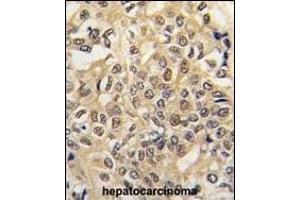 Formalin-fixed and paraffin-embedded human hepatocarcinoma tissue reacted with UBE1 antibody (C-term) (ABIN388844 and ABIN2839150) , which was peroxidase-conjugated to the secondary antibody, followed by DAB staining. (E1 Ubiquitin (AA 1026-1058), (C-Term) antibody)