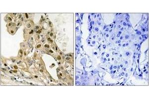 Immunohistochemistry analysis of paraffin-embedded human breast carcinoma, using p53 (Phospho-Thr387) Antibody. (p53 antibody  (pThr387))