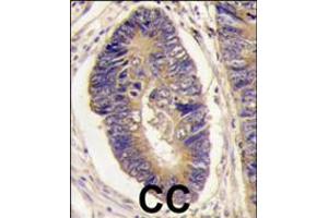 Formalin-fixed and paraffin-embedded human colon carcinoma tissue reacted with PTPH1 antibody , which was peroxidase-conjugated to the secondary antibody, followed by DAB staining. (PTPN3 antibody  (AA 366-397))