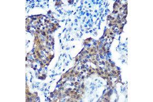 Immunohistochemistry of paraffin-embedded human cervix cancer using [KO Validated] CDKN2A/p16INK4a Rabbit mAb (ABIN6131541, ABIN6139280, ABIN6139282 and ABIN7101380) at dilution of 1:100 (40x lens). (CDKN2A antibody)