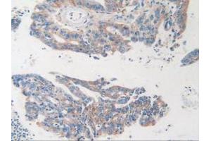 IHC-P analysis of Human Rectum Cancer Tissue, with DAB staining. (MVP antibody  (AA 2-272))