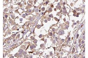 ABIN6267501 at 1/100 staining human breast carcinoma tissue sections by IHC-P. (p21 antibody  (pThr145))