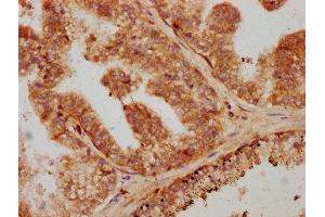 IHC image of ABIN7172814 diluted at 1:600 and staining in paraffin-embedded human prostate cancer performed on a Leica BondTM system. (TGFB1 antibody  (AA 281-390))