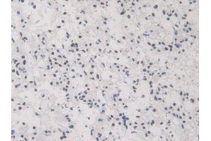 IHC-P analysis of Human Glioma Tissue, with DAB staining. (HNRNPA1 antibody  (AA 2-372))