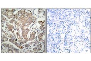 Immunohistochemical analysis of paraffin-embedded human breast carcinoma tissue using BAD (Ab-155) antibody (E021064). (BAD antibody)