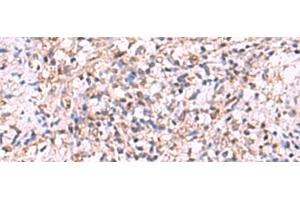 Immunohistochemistry of paraffin-embedded Human cervical cancer tissue using LMCD1 Polyclonal Antibody at dilution of 1:100(x200) (LMCD1 antibody)