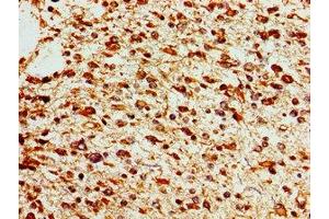 Immunohistochemistry of paraffin-embedded human glioma using ABIN7172611 at dilution of 1:100 (SOX17 antibody  (AA 177-414))