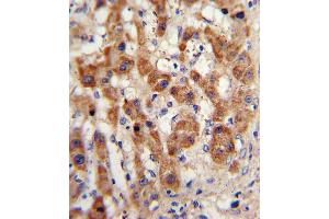 Formalin-fixed and paraffin-embedded human hepatocarcinoma with NAT2 Antibody , which was peroxidase-conjugated to the secondary antibody, followed by DAB staining. (NAT2 antibody  (C-Term))