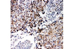 IHC-P: Prohibitin 2 antibody testing of human lung cancer tissue (Prohibitin 2 antibody  (Middle Region))