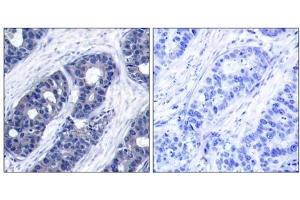 Immunohistochemical analysis of paraffin-embedded human breast carcinoma tissue, using IRS-1 (Ab-636) antibody (E021223). (IRS1 antibody)