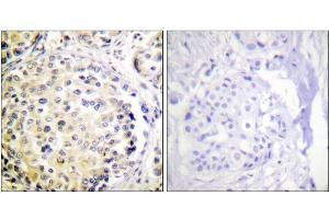 Immunohistochemistry analysis of paraffin-embedded human breast carcinoma tissue, using Vimentin Antibody. (Vimentin antibody  (Ser56))