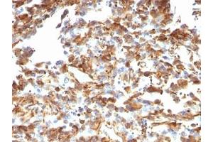 Immunohistochemistry (Formalin-fixed Paraffin-embedded Sections) (IHC (fp)) image for anti-Vimentin (VIM) antibody (ABIN3026904)