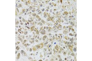 Immunohistochemistry of paraffin-embedded human lung cancer using DMAP1 antibody. (DMAP1 antibody)