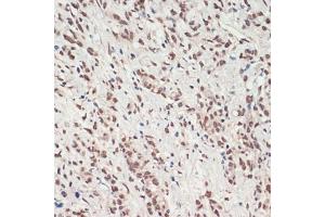 Immunohistochemistry of paraffin-embedded human gastric cancer using TDP-43/TARDB antibody (ABIN7270731) at dilution of 1:200 (40x lens). (TARDBP antibody  (AA 1-260))