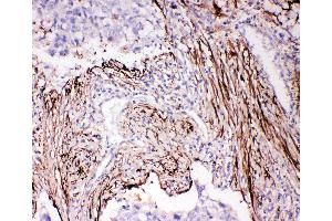 Anti-ADAM19 antibody, IHC(P) IHC(P): Human Lung Cancer Tissue (ADAM19 antibody  (N-Term))