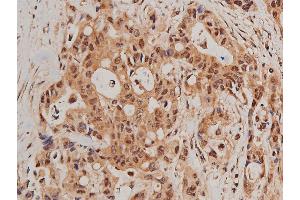 ABIN6267627 at 1/200 staining human colon cancer tissue sections by IHC-P. (FOXO1 antibody  (pSer319))