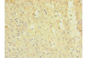 Immunohistochemistry of paraffin-embedded human liver cancer using ABIN7172869 at dilution of 1:100 (TRPM7 antibody  (AA 756-855))