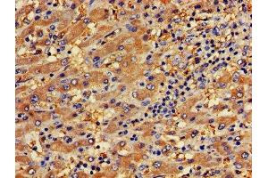 IHC image of ABIN7163576 diluted at 1:400 and staining in paraffin-embedded human liver cancer performed on a Leica BondTM system. (CD31 antibody  (AA 525-586))